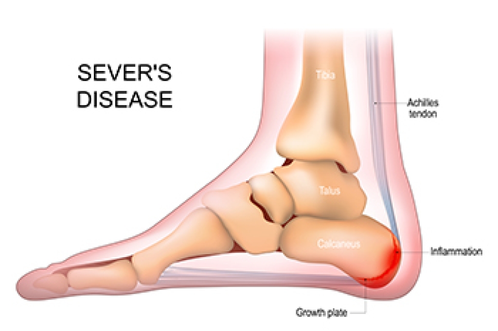 Recognizing Sever’s Disease in Children
