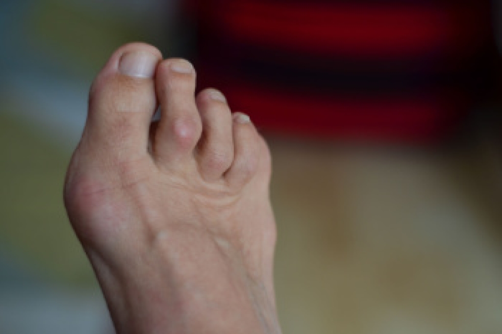 Why Prompt Hammertoe Treatment Matters