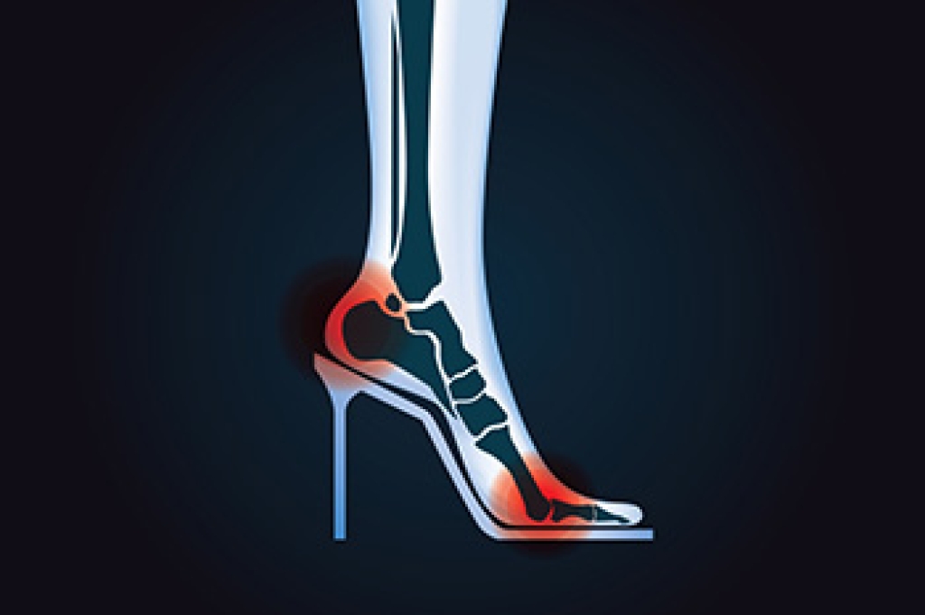 How High Heels Contribute to Common Foot Deformities and Pain