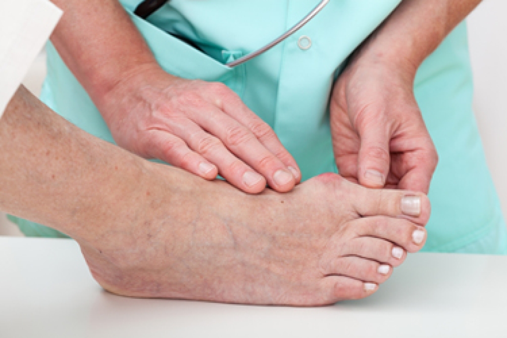 How a Podiatrist Can Help With Bunions